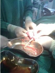 Foto operasi cacing 0,5kg dari perut bocah