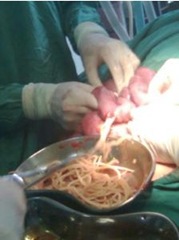 Foto operasi cacing 0,5kg dari perut bocah - 2